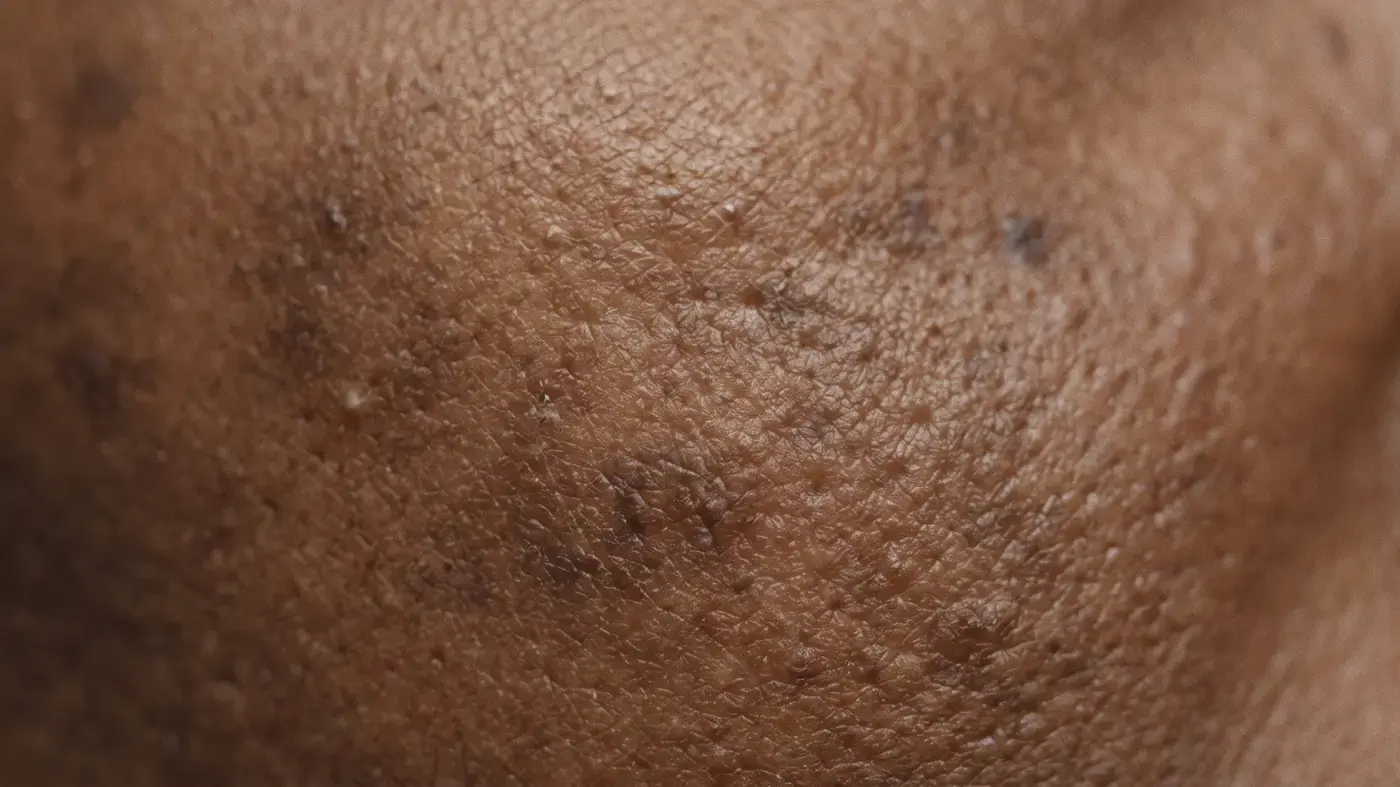 Close detail of deeper-toned skin with scattered darker patches of uneven pigment