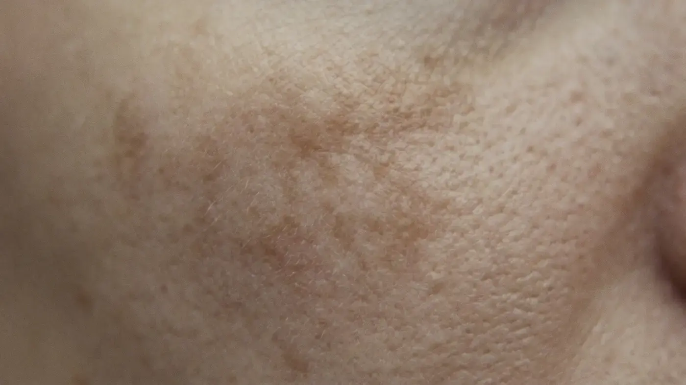Soft blotchy patches of darker pigment spreading across the upper cheek