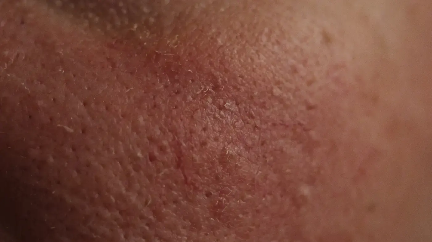 Diffuse flushing across the cheek with fine visible capillaries threading through it