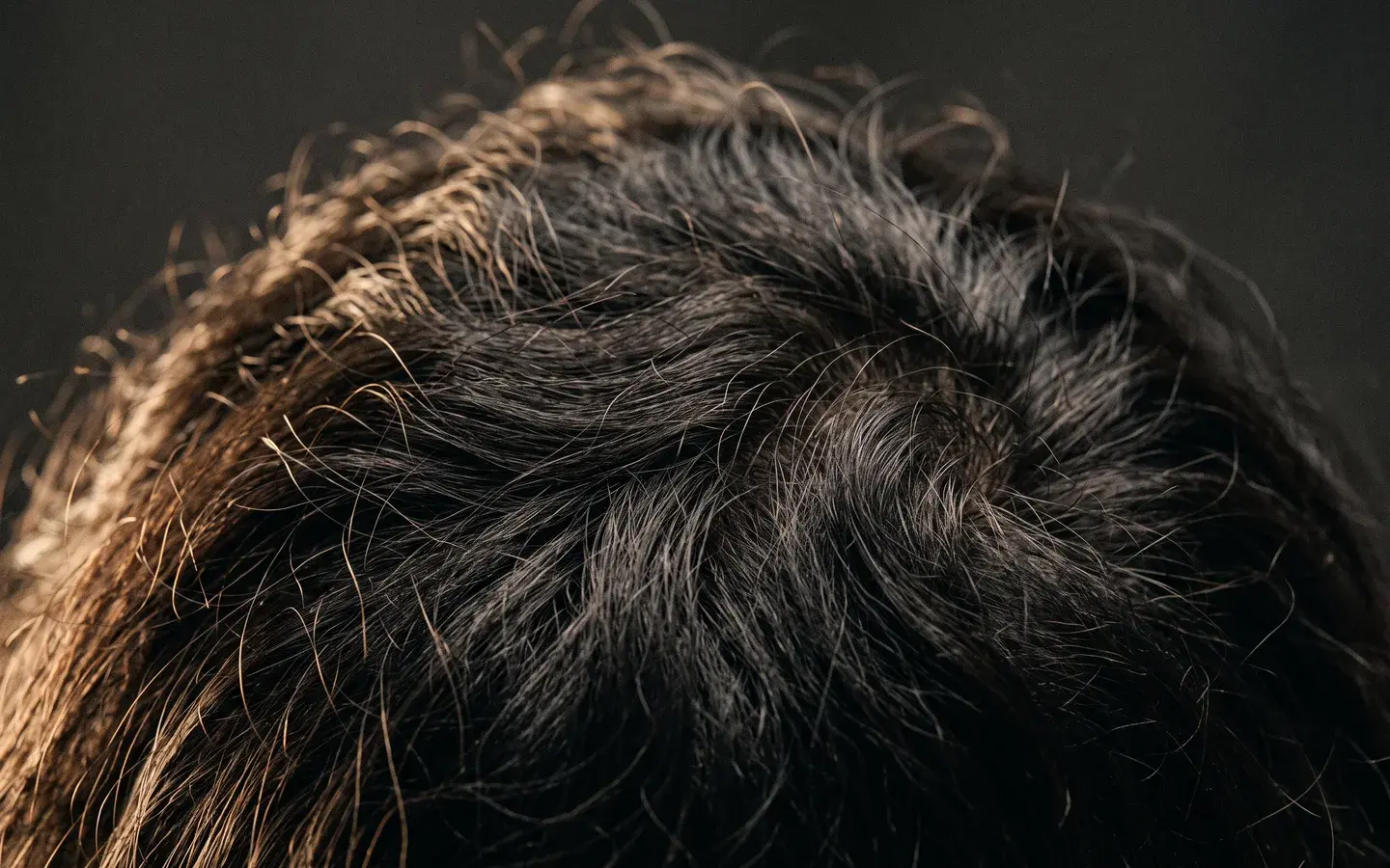 Hair Transplant in practice at Shookra, Dubai