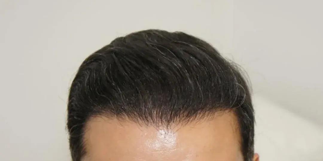 Case 01 — after hair transplant, performed by Dr. Amar Helali