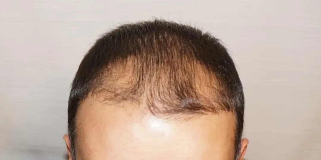 Case 01 — before hair transplant, performed by Dr. Amar Helali