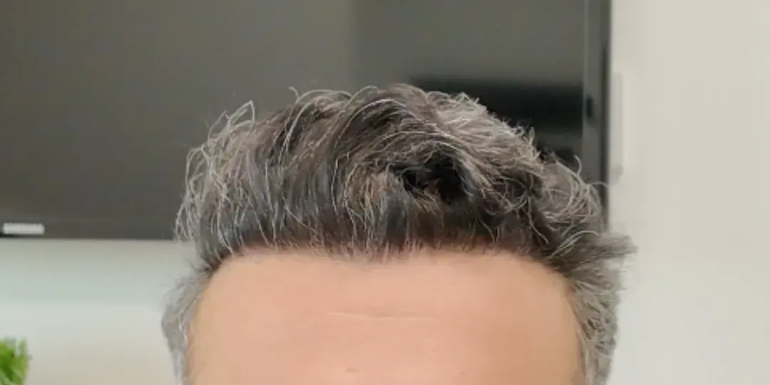 Case 02 — after hair transplant, performed by Dr. Amar Helali
