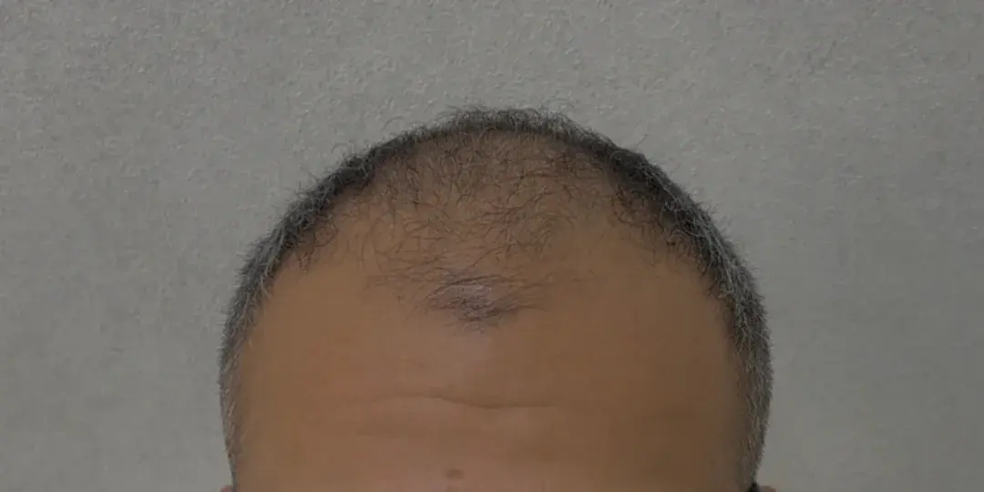 Case 02 — before hair transplant, performed by Dr. Amar Helali