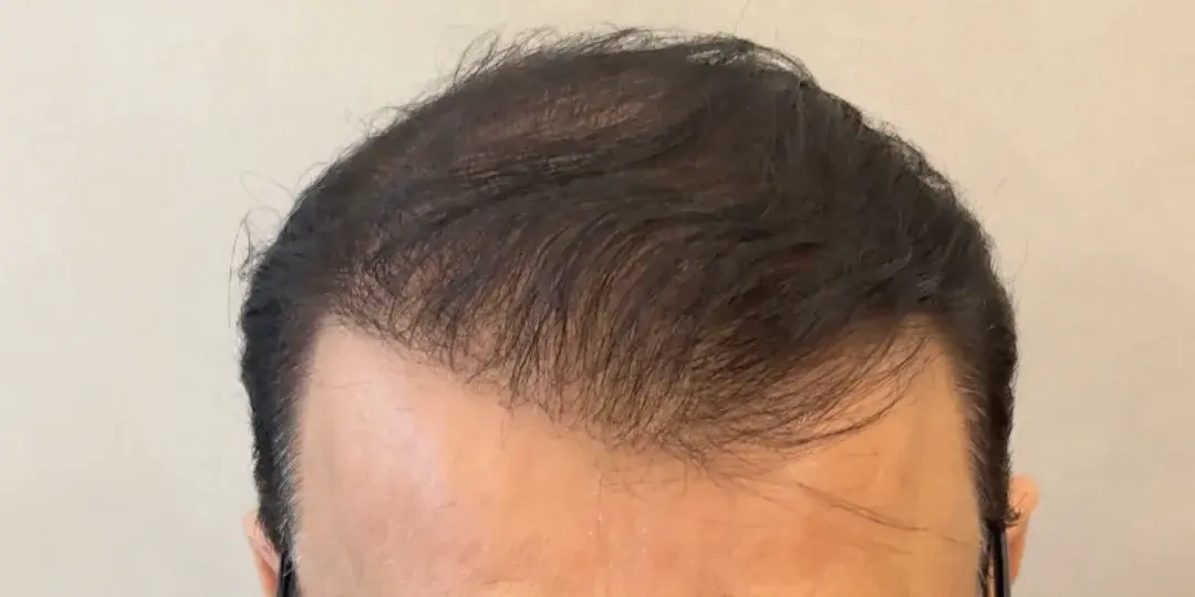 Case 03 — after hair transplant, performed by Dr. Amar Helali