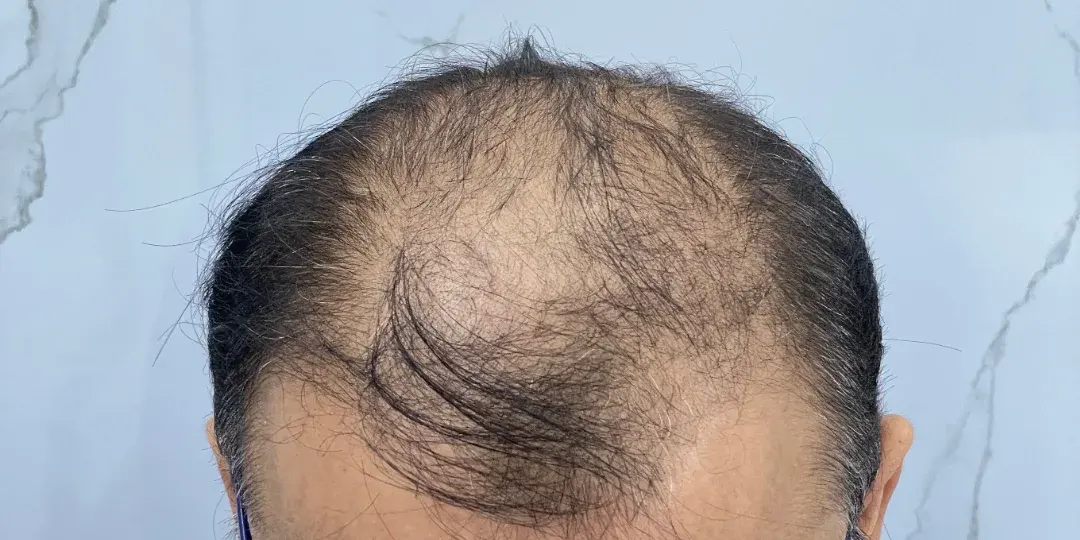 Case 03 — before hair transplant, performed by Dr. Amar Helali