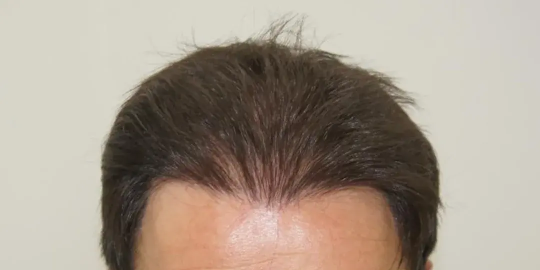 Case 04 — after hair transplant, performed by Dr. Amar Helali