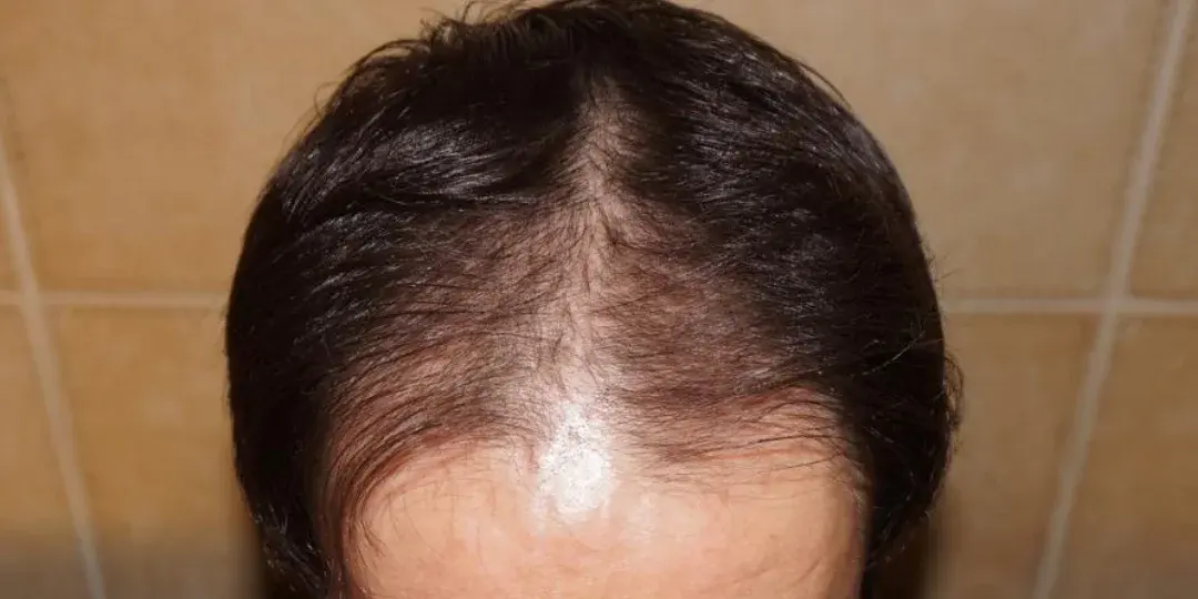 Case 04 — before hair transplant, performed by Dr. Amar Helali