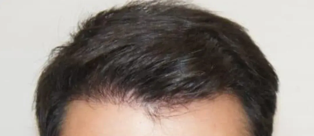 Case 05 — after hair transplant, performed by Dr. Amar Helali