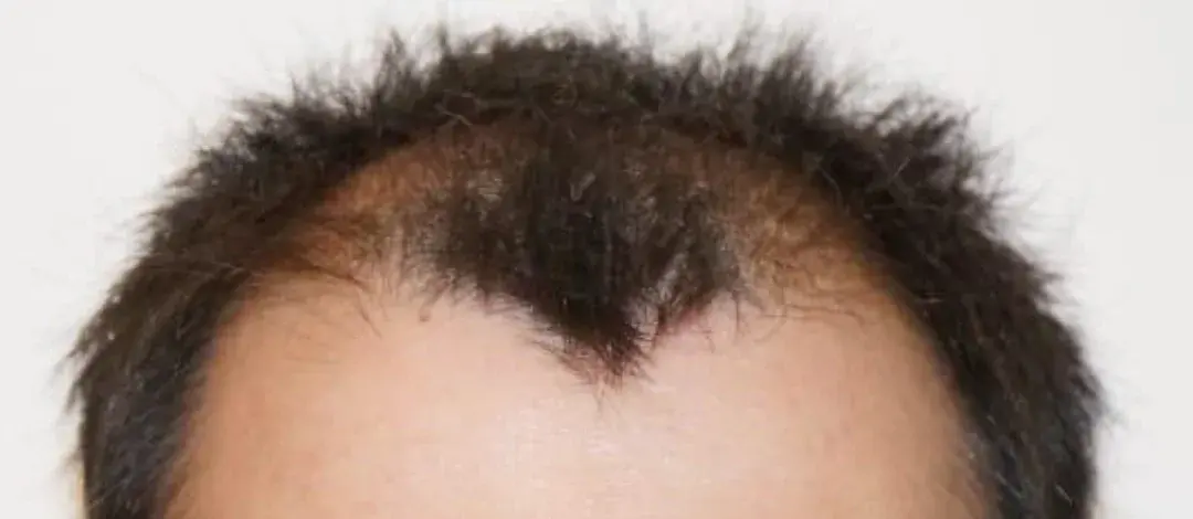 Case 05 — before hair transplant, performed by Dr. Amar Helali
