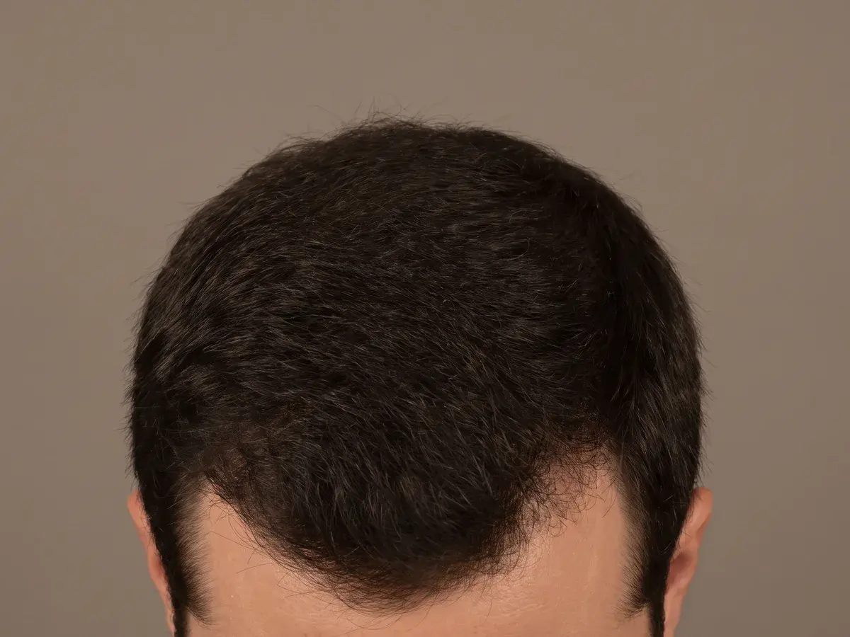 Reference illustration of a scalp with full density and only slight softening at the temples
