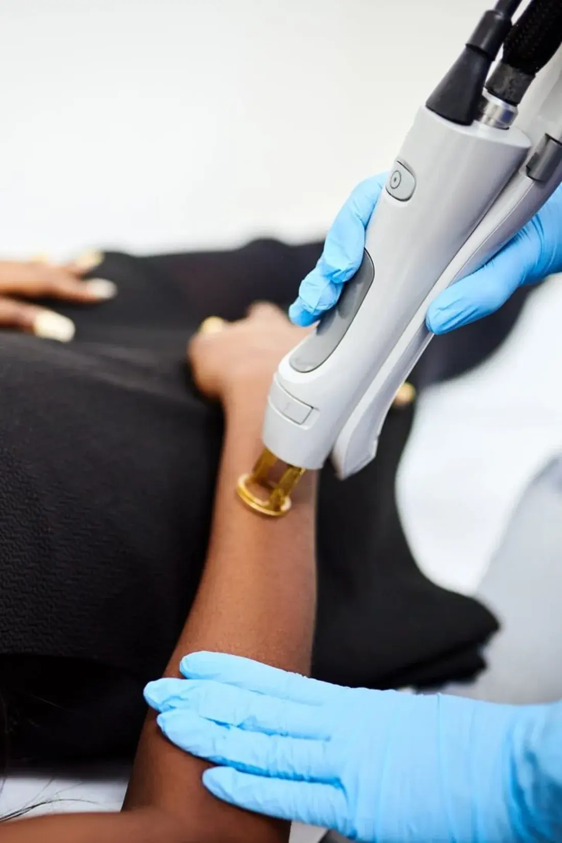 Laser Hair Removal in practice at Shookra, Dubai