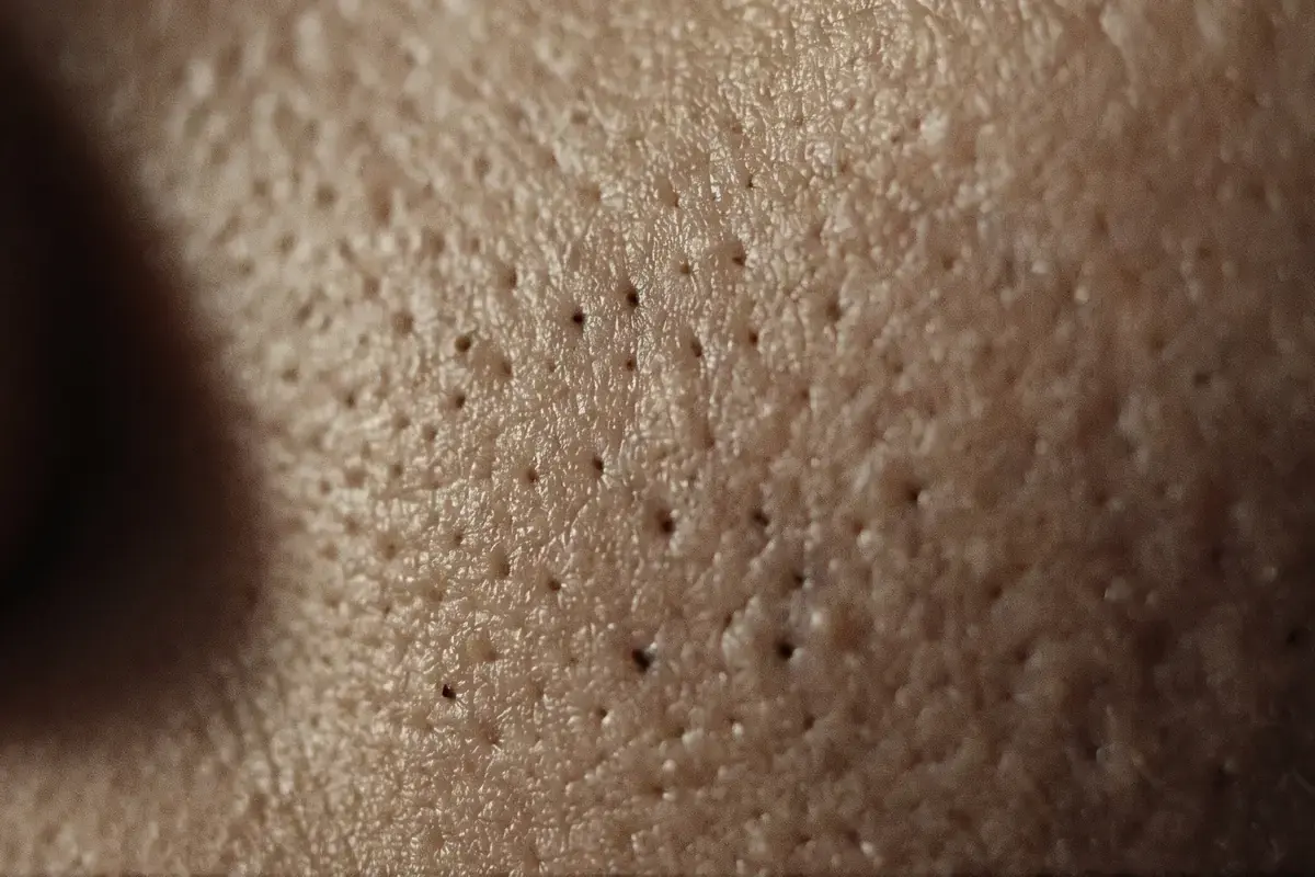 Close detail of skin with narrow, deep, small-diameter pitted scars scattered across the surface