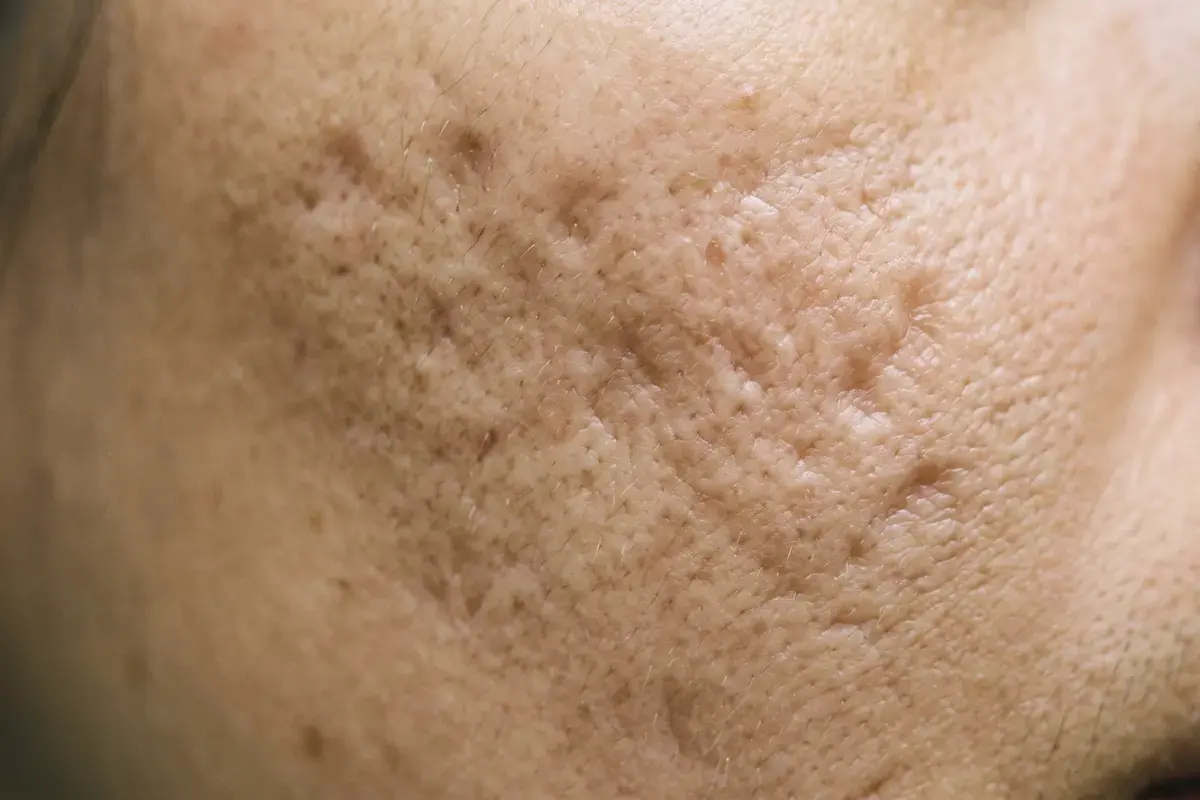 Close detail of skin with broad, soft-edged shallow depressions giving an uneven undulating surface